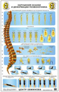 Плакат Нарушение осанки и деформации позвоночника