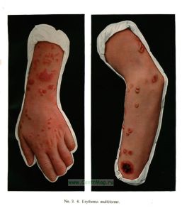 Атлас болезней кожи, с включением важнейших венерических заболеваний