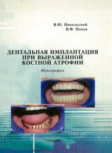 Дентальная имплантация при выраженной костной атрофии