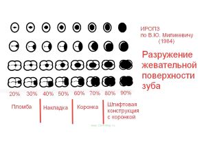Плакат ИРОПЗ (индекс разрушения окклюзионной поверхности зуба) по В.Ю. Миоикевичу 1984 г.