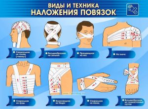 Плакат Виды и техника наложения повязок