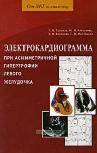 Электрокардиограмма при асимметричной гипертрофии левого желудочка